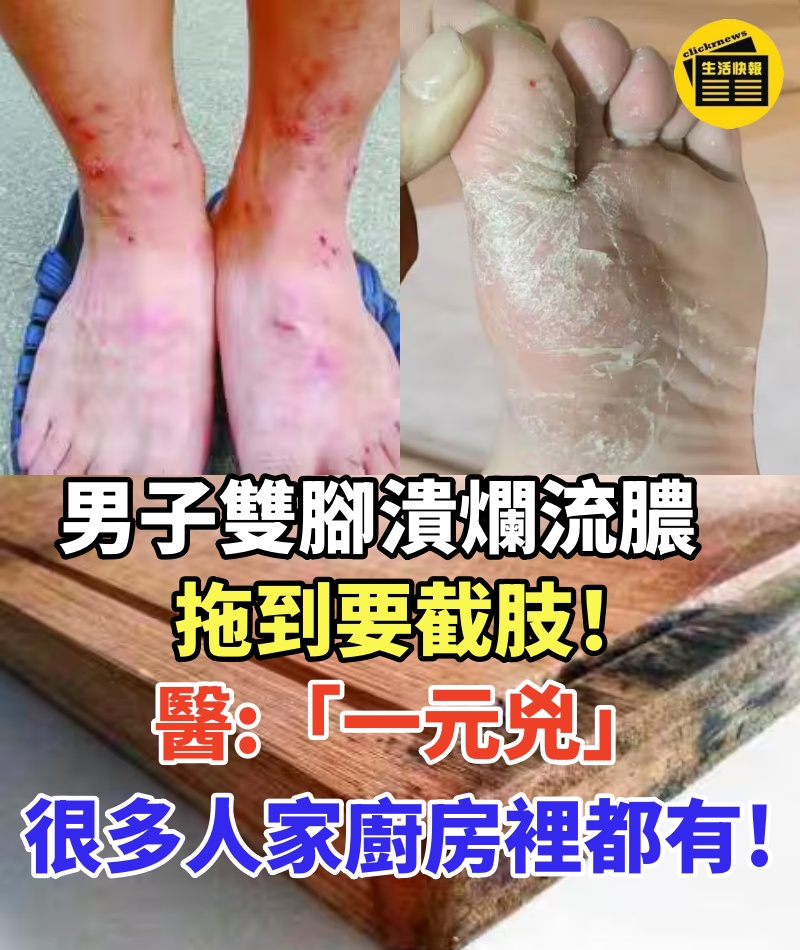 男子雙腳潰爛流膿拖到要截肢!醫生揪出「一元兇」:很多人家廚房裡都有!