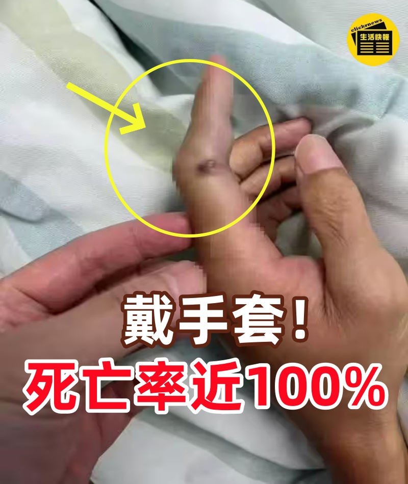 戴手套！戴手套！死亡率近100%