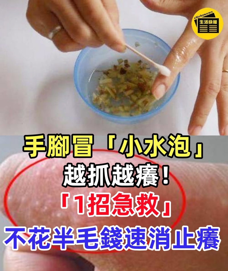 手腳狂冒「小水泡」越抓越癢！醫師警告：千萬別抓「1招急救」不花半毛錢速消止癢