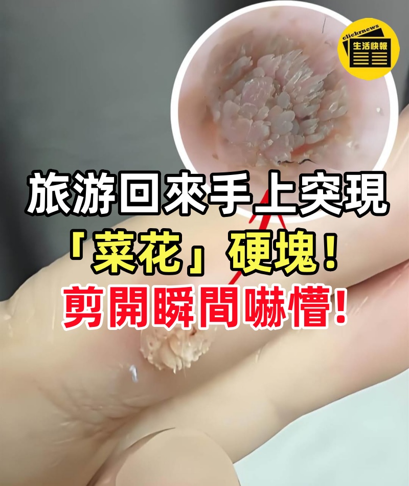 女子旅游回來手上突現「菜花」硬塊!剪開瞬間嚇懵,醫生急喊:酒店這些「隱形雷區」打死別碰!